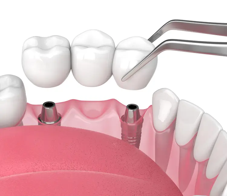 3D-Darstellung einer implantatgetragenen Brücke im Unterkiefer