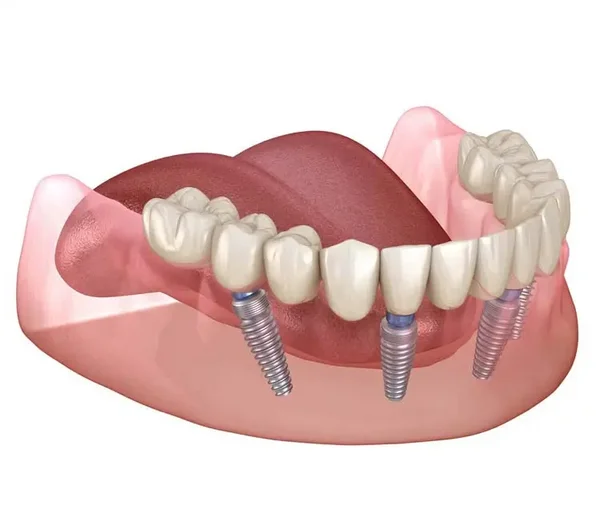 3D-Darstellung einer festen Brücke im Unterkiefer, die auf vier Implantaten befestigt ist.