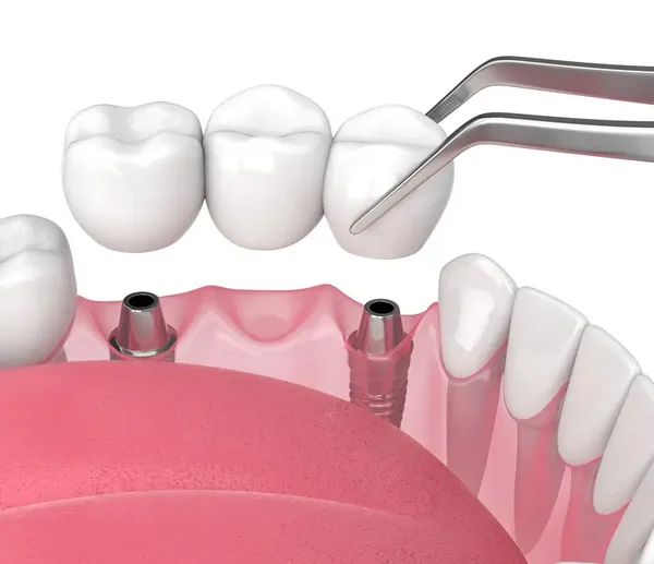 3D-Darstellung einer implantatgetragenen Brücke im Unterkiefer
