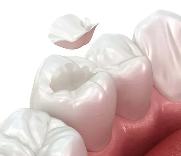 3D-Darstellung einer Zahnfüllung: Ein Inlay wird in einen vorbereiteten Backenzahn eingesetzt