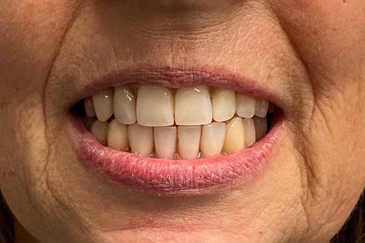 Patientenbild Zähne Wurzelbehandlung 