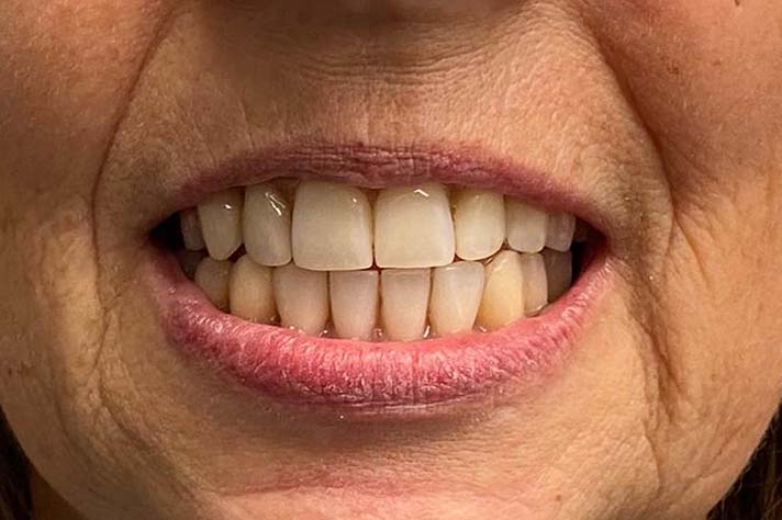 Patientenbild Zähne Wurzelbehandlung