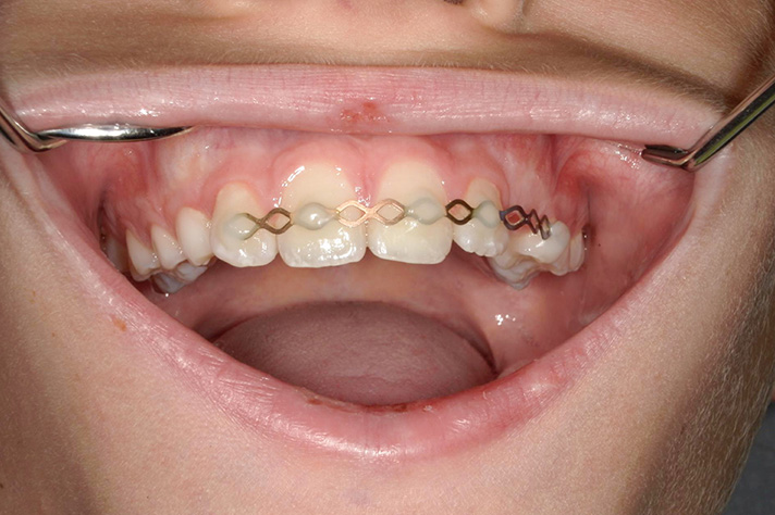 Patientenbild Oberkiefer Traumaschiene AllDent 